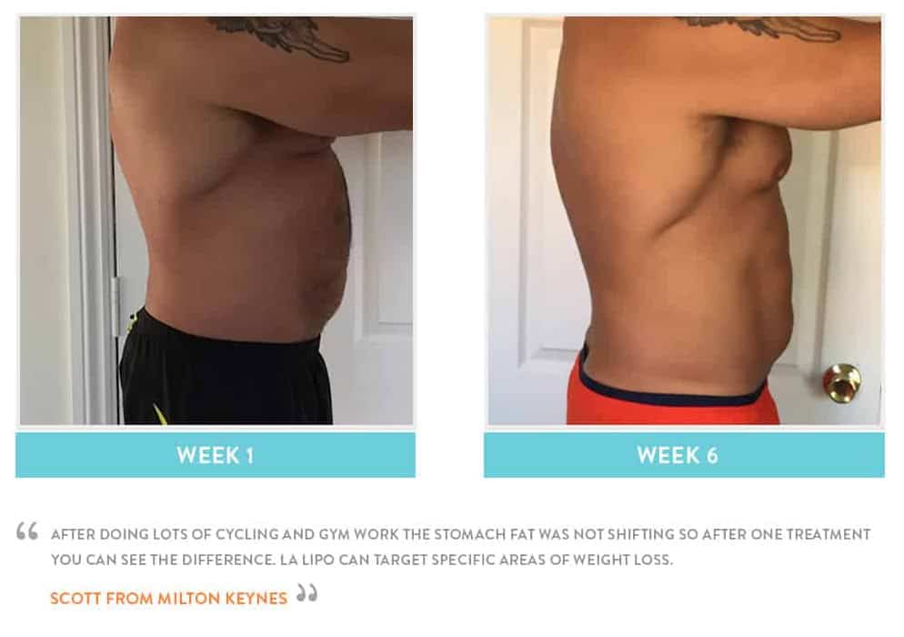 Before & After Stomach Fat Crewe