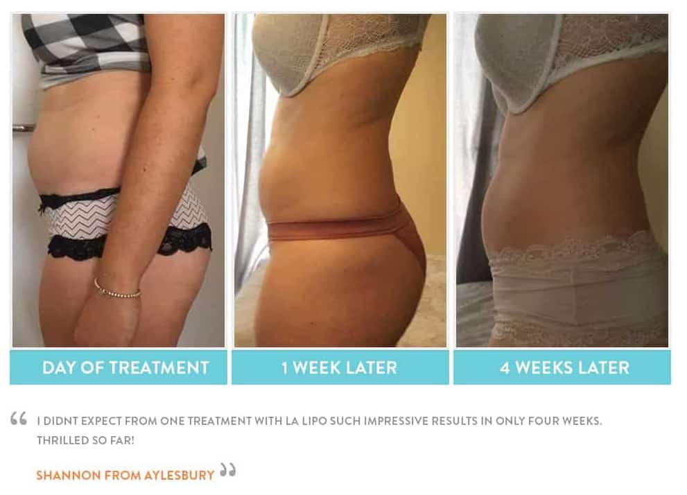 before, Cryolipolysis Crewe