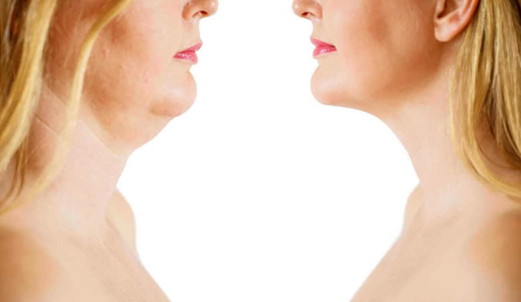 Double Chin treatment Crewe before and after results
