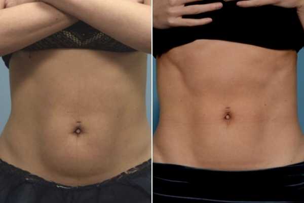 body sculpting FAQs Crewe