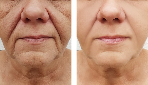 Learn more about Morpheus8 Treatment Crewe today!