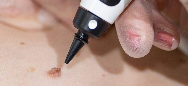 After Skin Tag Removal Crewe