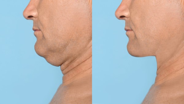 Which Non-Surgical Treatments Work Best for Jowls and Loose Skin Crewe?