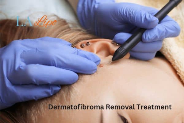 Dermatofibroma Removal Treatment Crewe