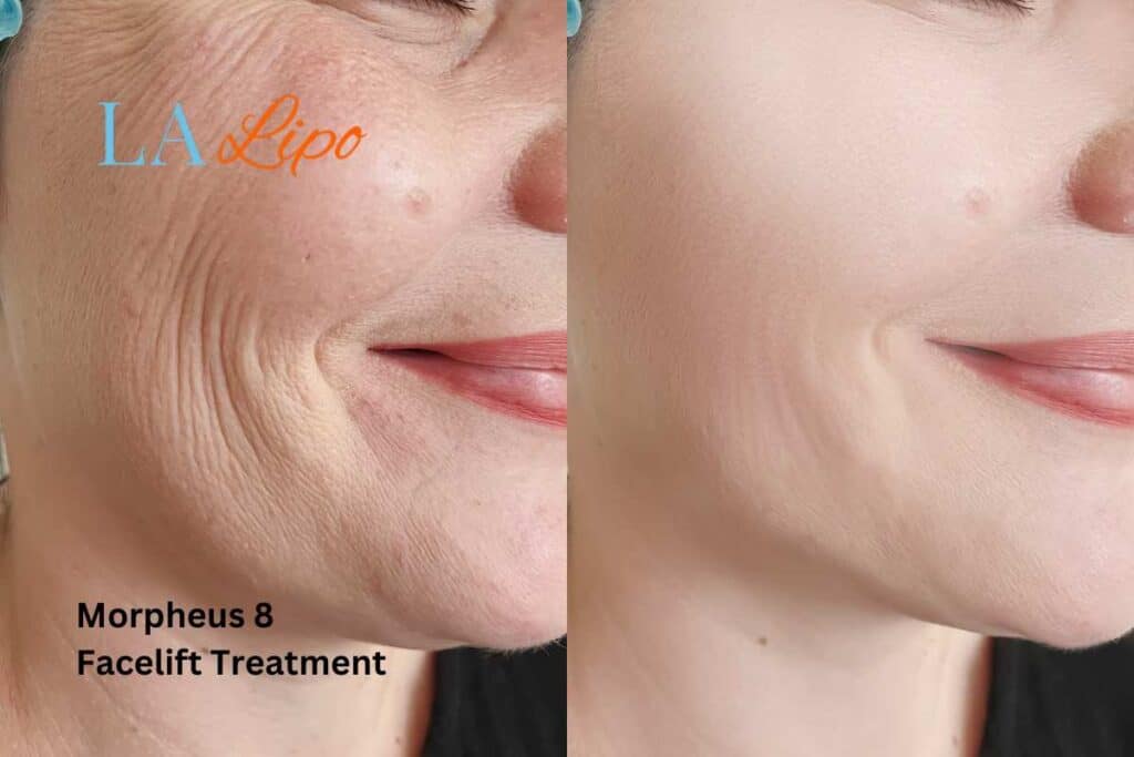 Morpheus8 Treatment Crewe for flawless skin! Call us today!