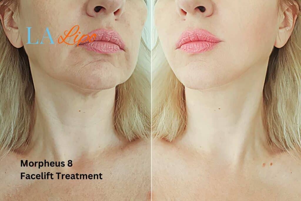 Turn back time with Morpheus8 Treatment Crewe