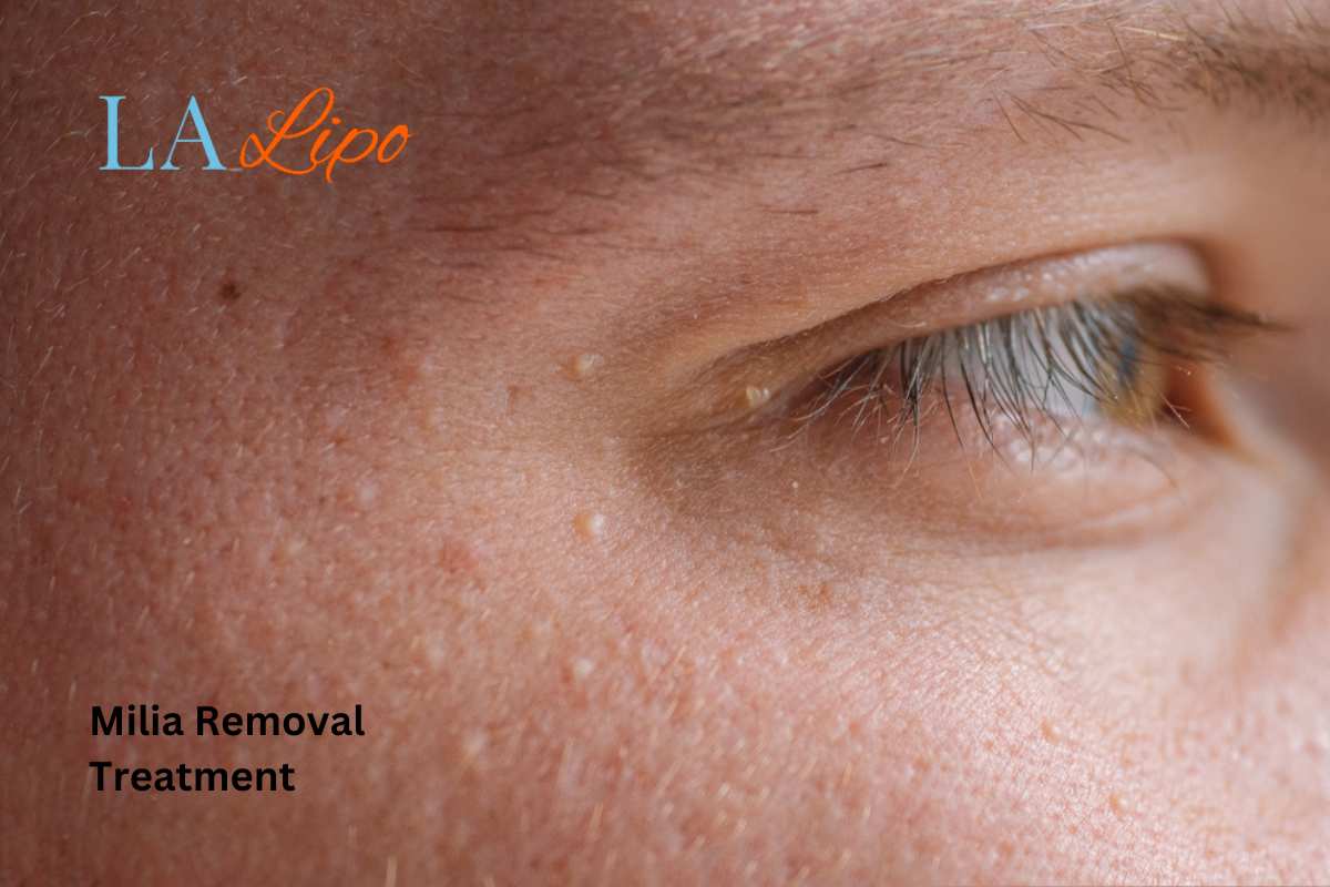 Cryopen Milia Removal: Is It the Easiest and Safest Option Crewe?