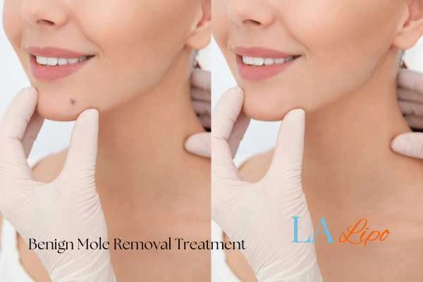 woman's before and after mole removal Crewe results