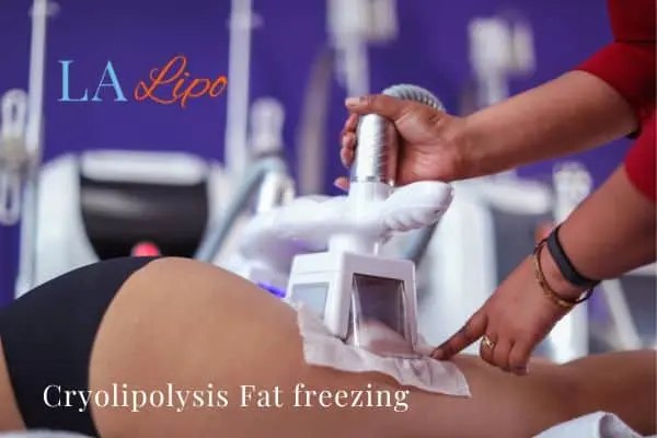women getting fat freezing Crewe
