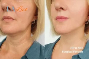 hi-fu for wrinkles Crewe before and after results
