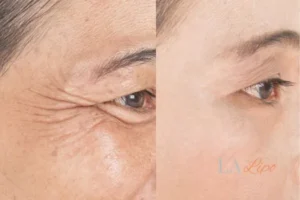 Before and after results of woman - HI-fu wrinkles reduction treatment Crewe