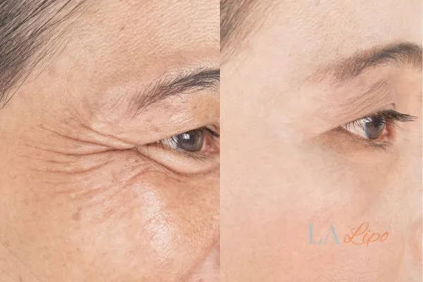 Before and after results of woman - HI-fu wrinkles reduction treatment Crewe