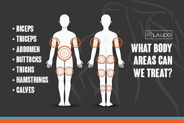 Graphic to show areas you can have LA-EMS Body Sculpting Crewe treatment.