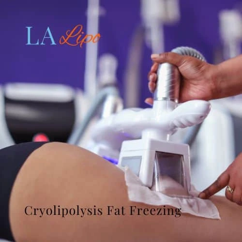 fat freezing - Cryolipolysis Crewe