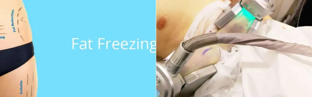 Fat freezing Crewe on multiple areas of the body