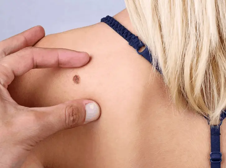 woman having mole removal Crewe consultation before treatment.