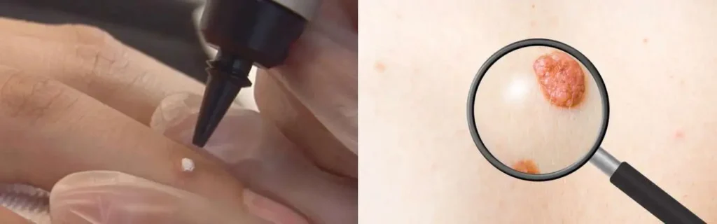 Cryopen for mole removal Crewe - speak to our team today!
