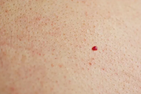 close up of a cherry angioma Crewe
