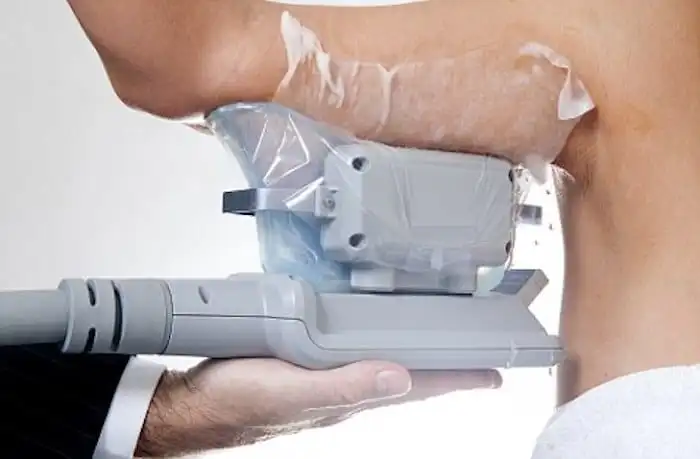 Picture of fat freezing Crewe on the upper arms.