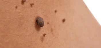 image of a skin tag Crewe