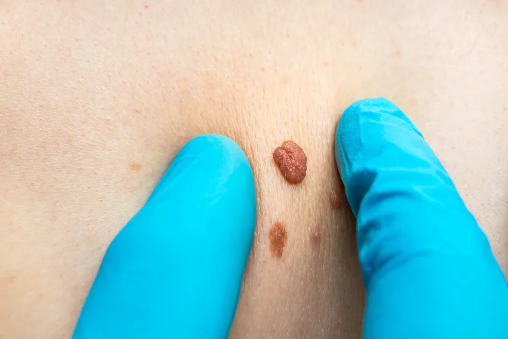Consultant examining a skin tag Crewe