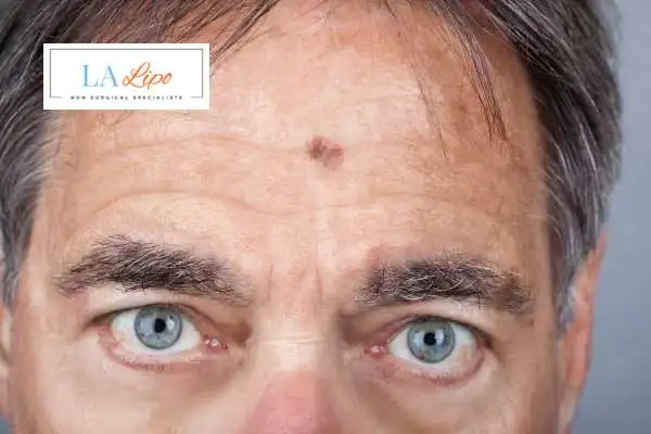 Solar Lentigo Removal Crewe image of man with mark on his forehead