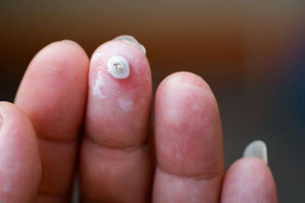 wart on person finger - cryotherapy to treat from LA LIPO Crewe