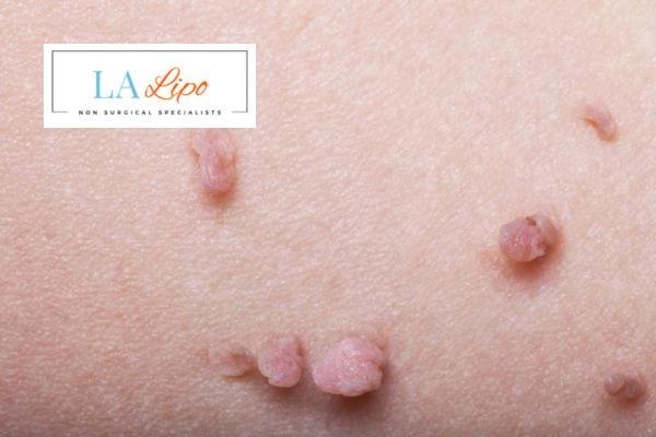 Does cryopen skin tag removal Crewe hurt? Find out now call our team today!