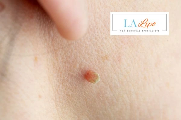 Book skin tag removal Crewe today speak to our team now!