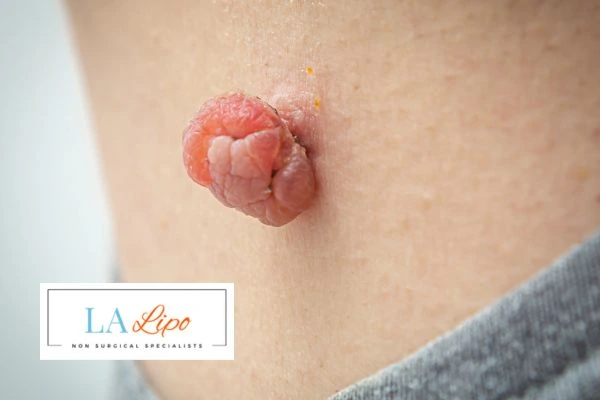 Interested in skin tag removal Crewe? Concerned about the pain? Find out more today!