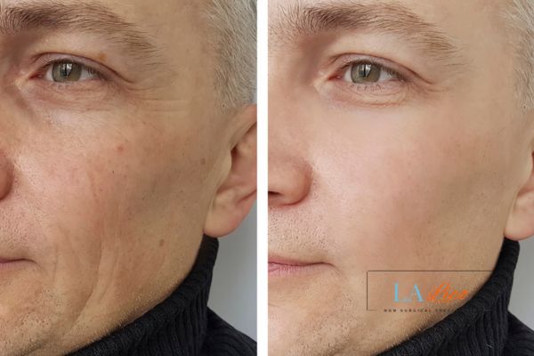 See the amazing results of Morpheus8 Treatment Crewe!
