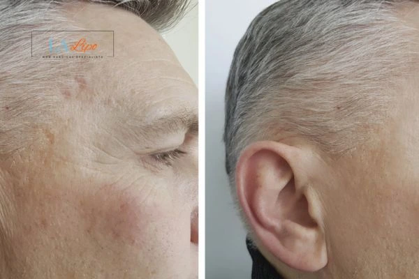Mens Before & After Morpheus 8 Results Crewe