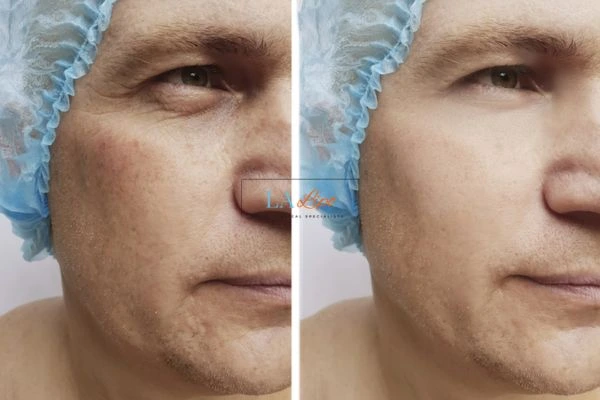 Before and after Morpheus 8 Results Crewe