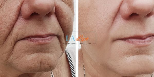 Older lady deeper wrinkle reduction - LA LIPO Morpheus 8 Results Crewe