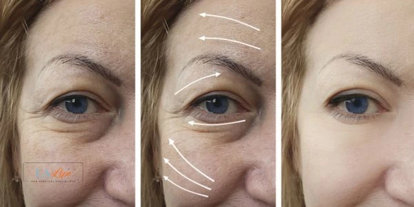 Amazing eye lift Morpheus 8 results Crewe