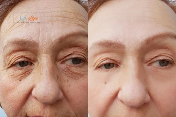 The powerful benefits of Morpheus8 Treatment Crewe - Call Our team today!