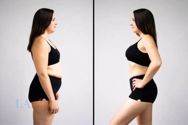 Picture of womans before and after using LA-EMS body sculpting to improve her core strength Crewe