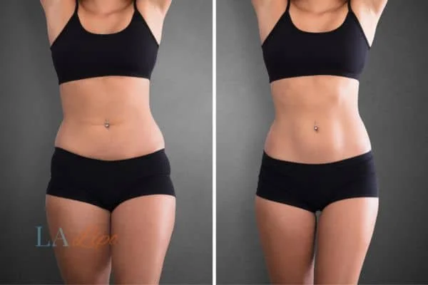 before and after results of non-surgical treatment to help a woman's body image and mental health Crewe
