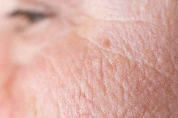 close up picture of a woman's face showing an age spot Crewe