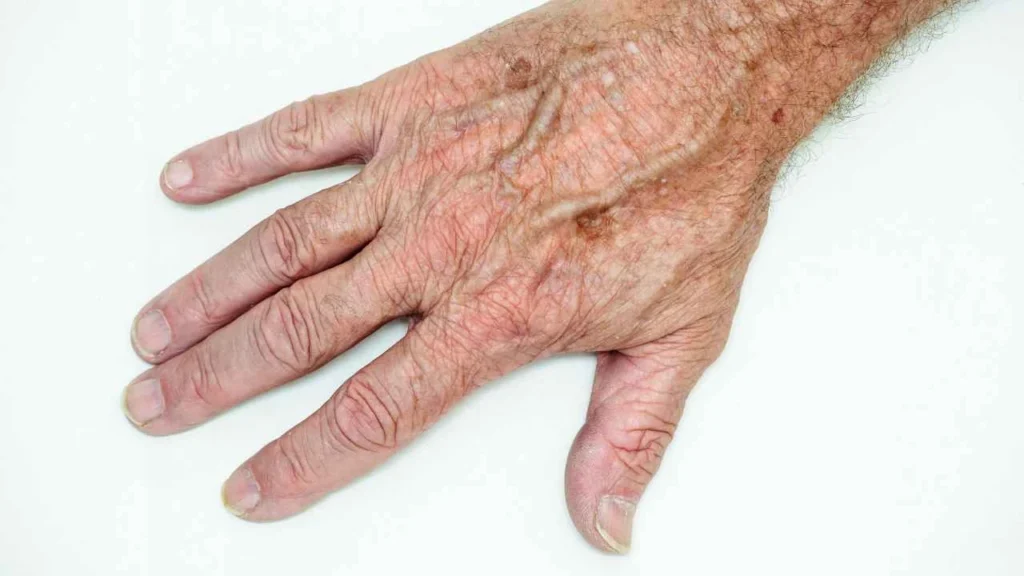 Male hand showing age spot Crewe