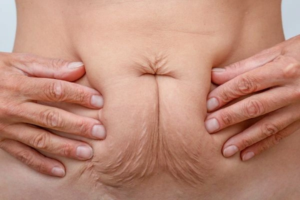 Image of a woman's stomach with loose skin - example of skin tightening Crewe options