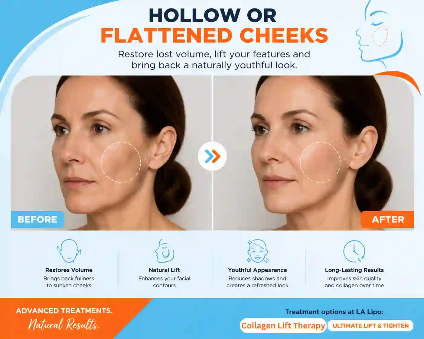 Sign #4: Hollow or Flattened Cheeks Crewe