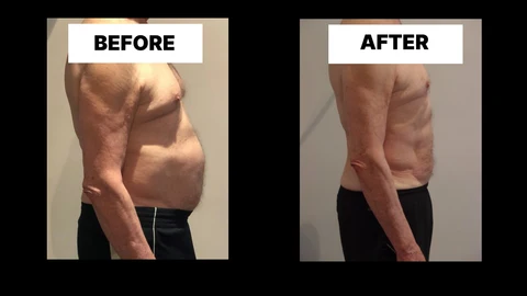 What Symptoms Can Diastasis Recti Cause in Men? Weak Core, Back Pain and Poor Posture Crewe